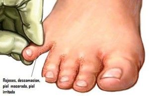 Pie De Atleta Tratamiento Infección Por Hongos Remedios Para Hongos En Los Pies Remedio Hongos Pies