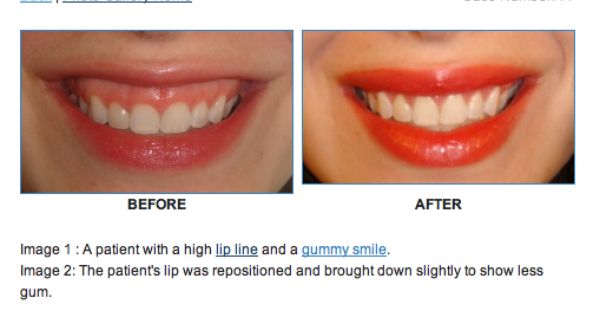 How To Fix A Crooked Smile With Botox