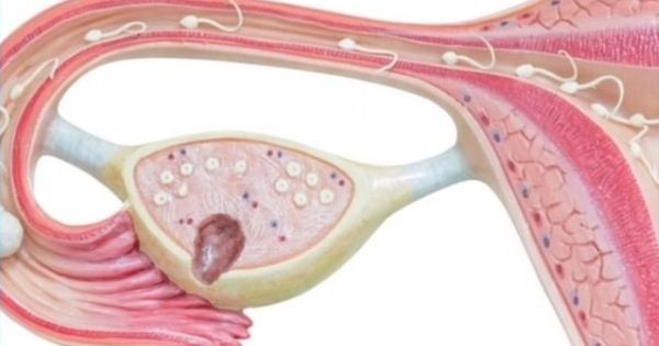 سبب تكيس المبايض Spoon Rest Tableware Polycystic Ovaries
