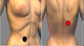 Terapia con imanes para adelgazar