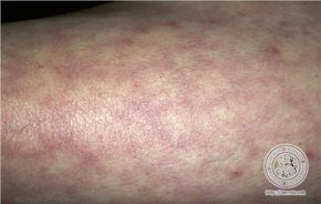 livedo reticularis mani