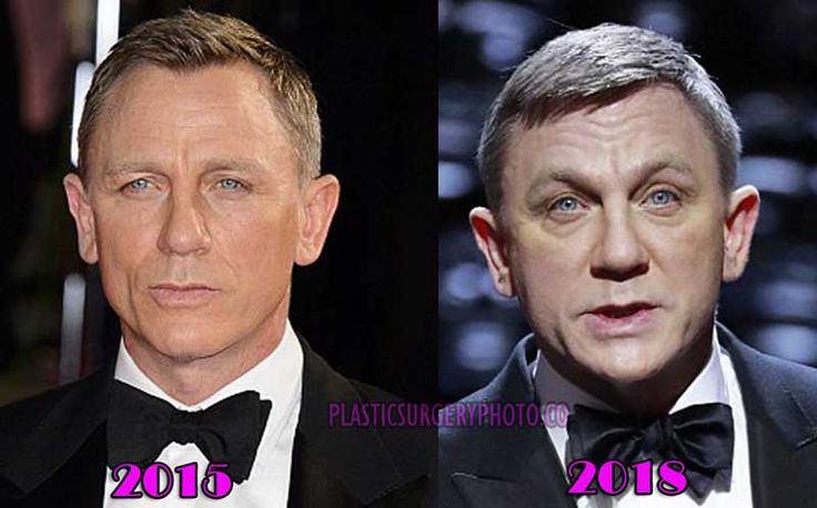 Daniel Craig Plastic Surgery Before and After Photos | Celebrity
