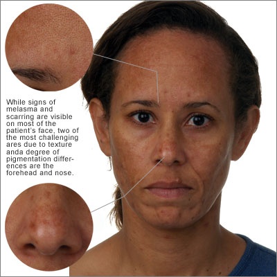Natural Way To Treat Chloasma Natural Way To Treat Chloasma
