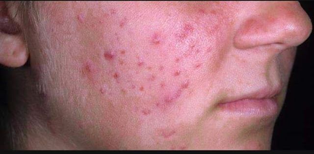 سر جمالي أفضل غسول للبشرة الدهنية المعرضة للحبوب In 2020 Problem Skin Acne How To Treat Acne How To Remove Pimples