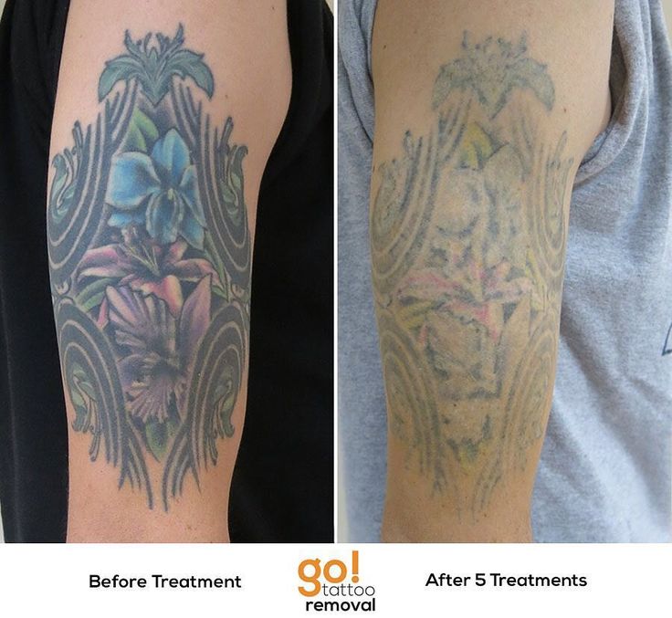 best 25 picosure tattoo removal ideas on pinterest natural best 25 picosure tattoo removal ideas on pinterest natural