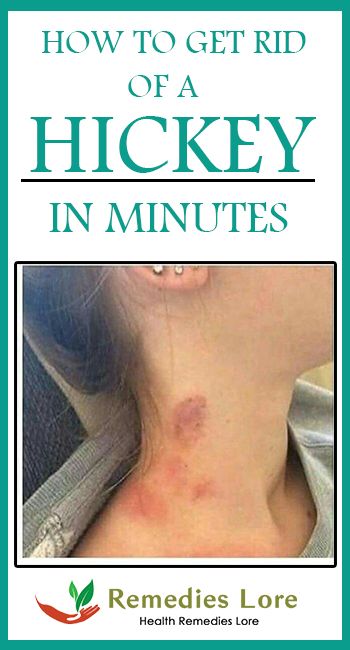 naturopathic herb hickey bottom Naturopathic herb hickey bottom