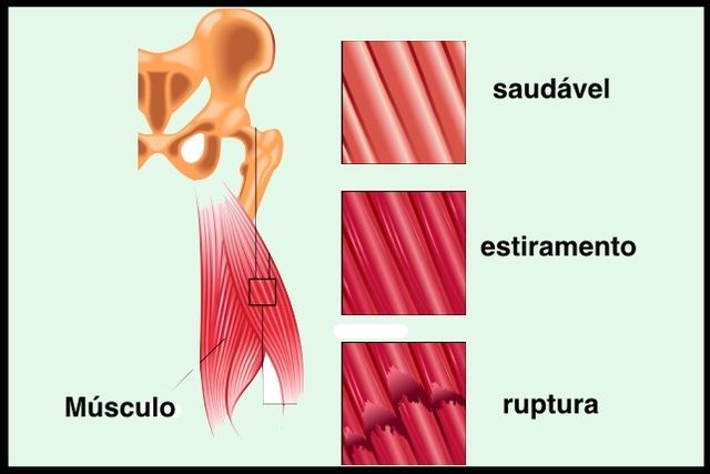 Panturrilha músculo na distendido um como tratar