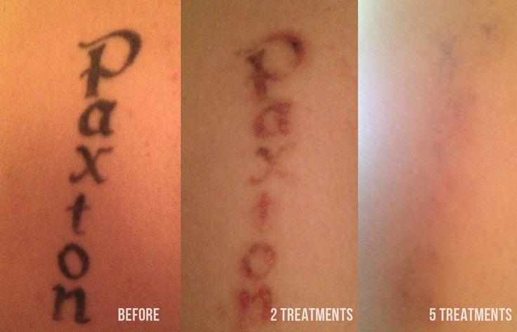 tattoo temoval before and after pictures tattoo removal and tattoo tattoo temoval before and after pictures tattoo removal and tattoo