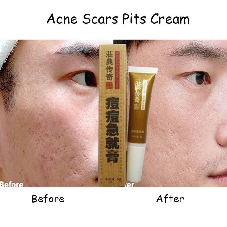 Cicatrices d'acné Fosse Crème éclaircissante anti acné crème pour enlever l...