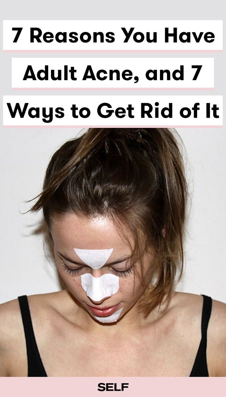 7 Reasons You Have Adult Acne, And 7 Ways To Get Rid Of It