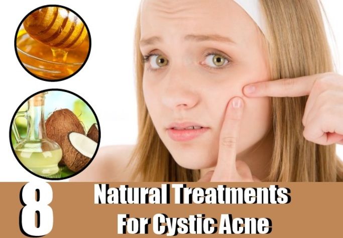 Natural Cystic Acne Treatment Options Natural Cystic Acne Treatment Options