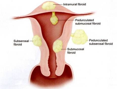 Cyst And Fibroids Natural Cure Cyst And Fibroids Natural Cure