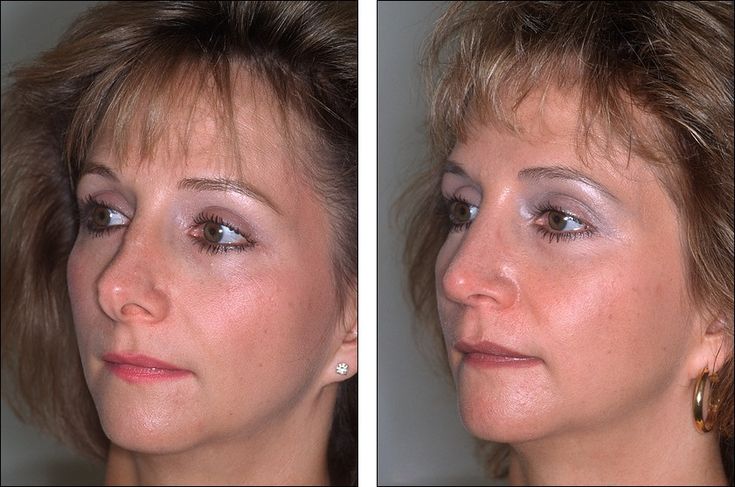 Filipino Before \ After Rhinoplasty Cosmetic Surgery by DrRaynald - plastic surgery consultant sample resume Filipino Before \ After Rhinoplasty Cosmetic Surgery by DrRaynald - plastic surgery consultant sample resume