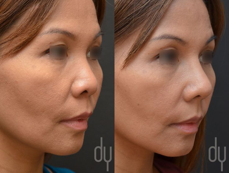 Plastic surgeon in ca for asian rhinoplasty