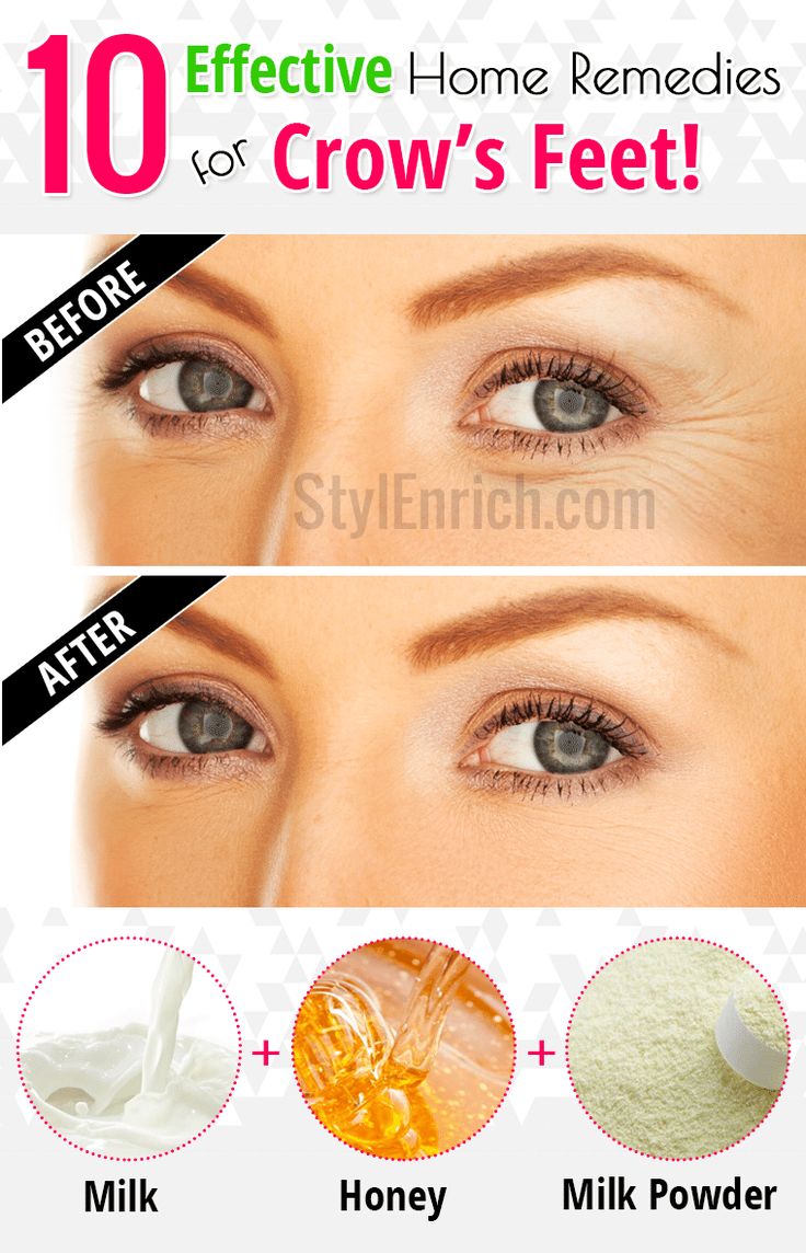 Natural Remedies For Crows Feet Natural Remedies For Crows Feet