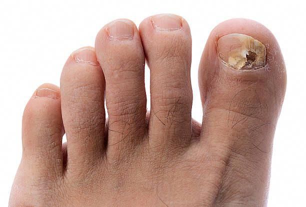 How To Get Rid Of Nail Fungus From Under Acrylic Nails Treatment For How To Get Rid Of Nail Fungus From Under Acrylic Nails Treatment For Fungal Infection Fungusundernailtreatment