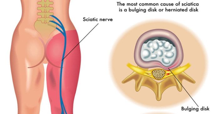 cramps cukorbetegség kezelése