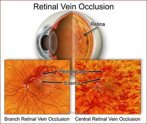 Natural Remedies For Retinal Vein Occlusion Natural Remedies For Retinal Vein Occlusion