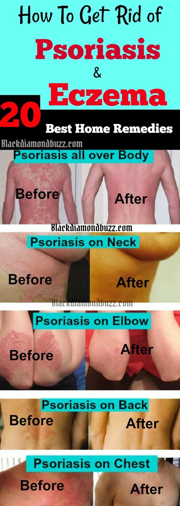 Home Remedies To Cure Eczema Fast Home Remedies To Cure Eczema Fast