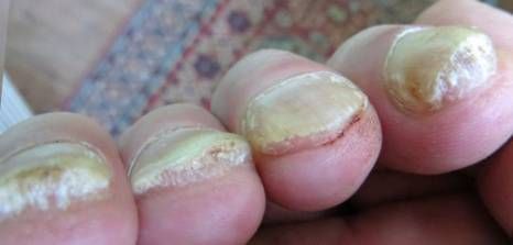Thickened Toenails Might Be The Result Of Aging But An Injury To Thickened Toenails Might Be The Result Of Aging But An Injury To Toenail And Fungus Can Also Reason For Thick