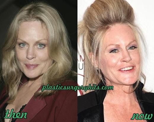 Beverly D’Angelo Plastic Surgery Before and After | Beverly d'angelo