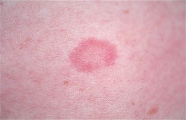Small Raised Red Ring On Skin Small Raised Red Ring On Skin