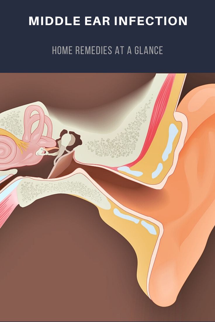 Middle Ear Infection Home Remedies at a Glance Ear infection home