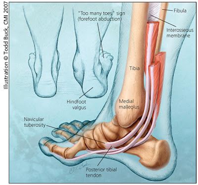 48 best Tendonitis images on Pinterest | Health, Health fitness and ... Posterior Tibial Tendon Dysfunction (PTTD): My story