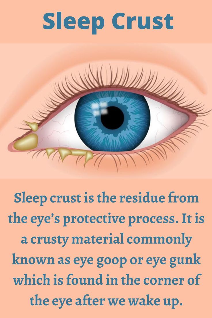 Crusty Eyes crusty-eyes