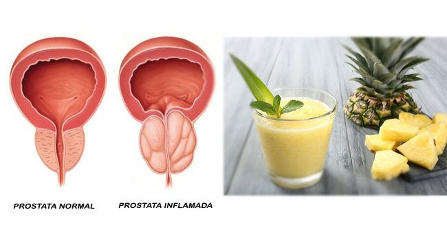 jugos para la próstata inflamada)