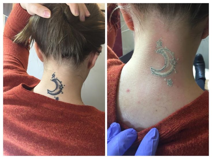 28 best tattoo removal images on pinterest html the o u0027jays and 28 best tattoo removal images on pinterest html the o u0027jays and