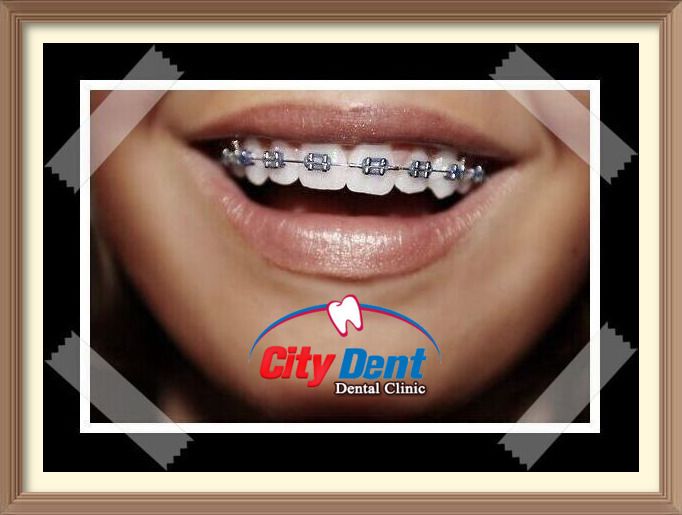 أنواع تقويم الأسنان و الأفضل بينهم مع مركز سيتي دينت Dental Clinic Dental Clinic