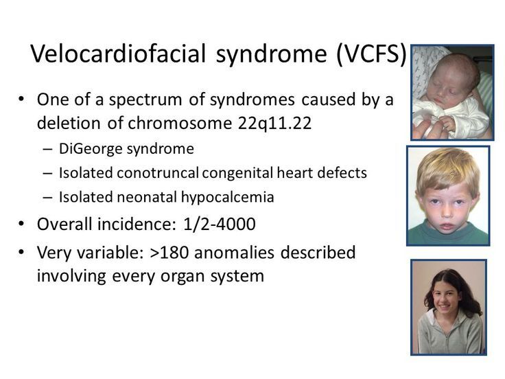 three different pictures of babies with the words velocardial syndrome vcfs