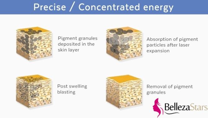 What Q Switched Ndyag Laser Treat For Nd Yag Laser Improve Skin Tone Skin Rejuvenation