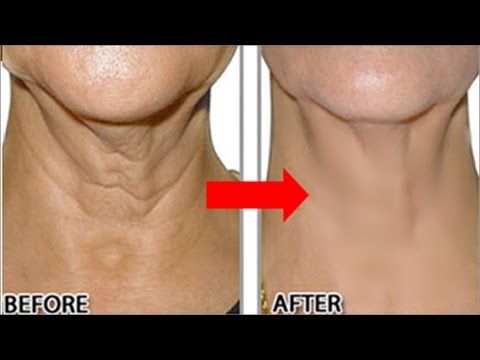 Get Rid Of Neck Lines Naturally Get Rid Of Neck Lines Naturally