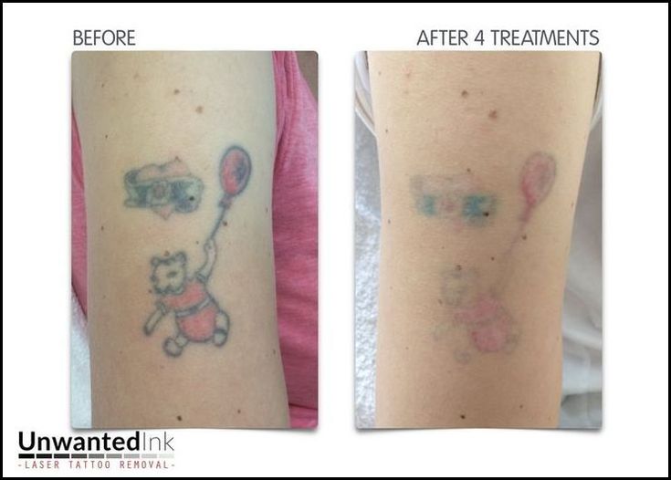 les 7733 meilleures images du tableau info about tattoo removal les 7733 meilleures images du tableau info about tattoo removal
