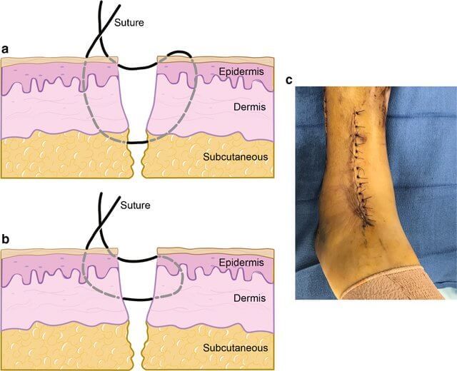 Allgower Donati Suture Technique Https Epomedicine Com Surgical Skills Allgower Donati Suture Technique Suture Techniques Sutures Medical Sutures