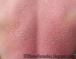 Fever Blister In Eye Natural Remedies Fever Blister In Eye Natural Remedies