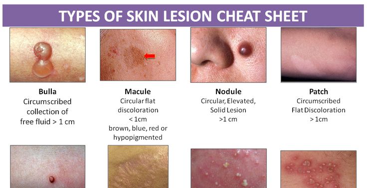 Types of Skin Lesion Cheat Sheet | SSA lookbook | Cheat sheets, Brain