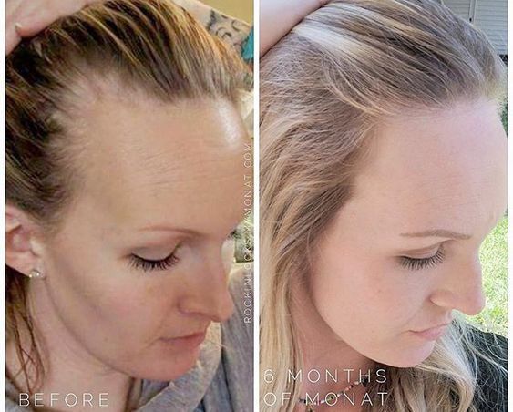 Hair Regrowth Fast and Naturally! | Monat hair, Hair loss women, Hair loss  men