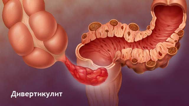 всё утрировано, лечение дивертикулита диета благодарю!
