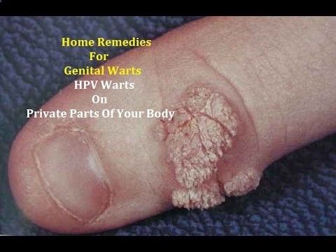 Genital warts on hands