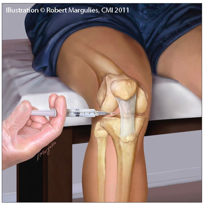 steroid injection into knee steroid injection into knee