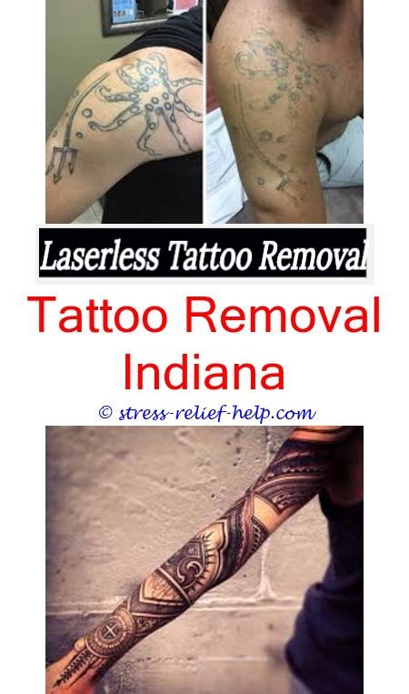 Affordable tattoo removal.Does tattoo removal cream work.Finger tattoo removal -...