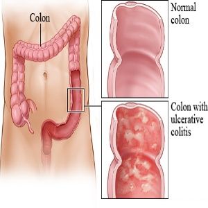 Colitis Ulcerosa Natural Remedies Colitis Ulcerosa Natural Remedies