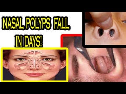 Post Nasal Drip Natural Remedies Australia Post Nasal Drip Natural Remedies Australia