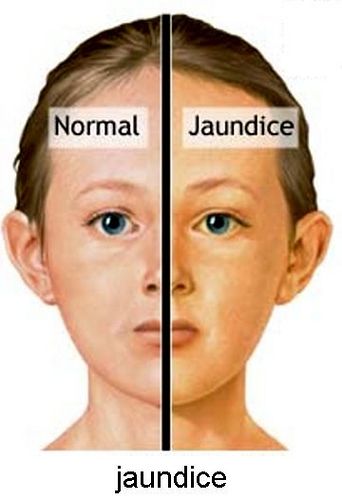 Natural Remedies For Jaundice In Adults Natural Remedies For Jaundice In Adults