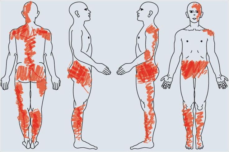 Wer den Arzt fragt, ob seine Schmerzen eine Fibromyalgie sein könnten, hat schn...