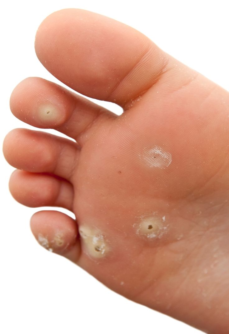 Natural Ways To Get Rid Of Hpv Warts Natural Ways To Get Rid Of Hpv Warts