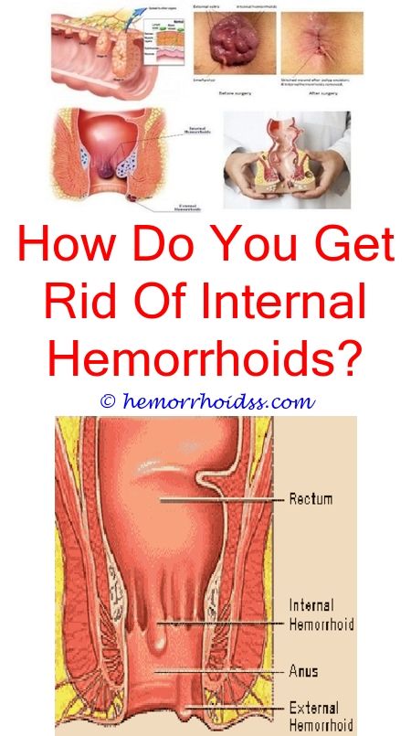 anal sex enema suppositories hemmorrhoids Pic of anal stimulation